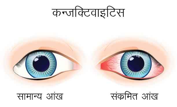 बरसात में आंखों का रखें खास ख्याल : एलर्जिक कन्जक्टिवाइटिस होने पर हो सकती है खुजली, आंखों से पानी आना और सूजन जैसी समस्याएं